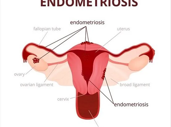 Symptoms, Risk Factors, and Diagnosis of Endometriosis