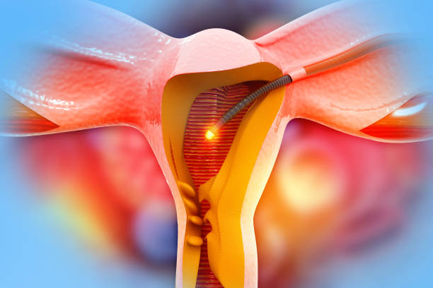 Medically accurate illustration of hysteroscopy of uterus. The appearance of the disease endometriosis. 3d illustration